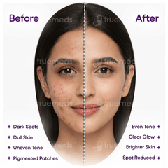 Kozilite H Skin Lightening Cream 20Gm Kozilite H Skin Lightening Cream 20Gm