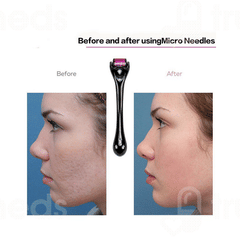 Elmask 0.5 Drs Titanium 540 Microneedle Derma Roller 1