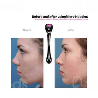 Elmask 0.5 Drs Titanium 540 Microneedle Derma Roller 1