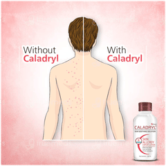 Caladryl Skin Soothing Solution 65ml