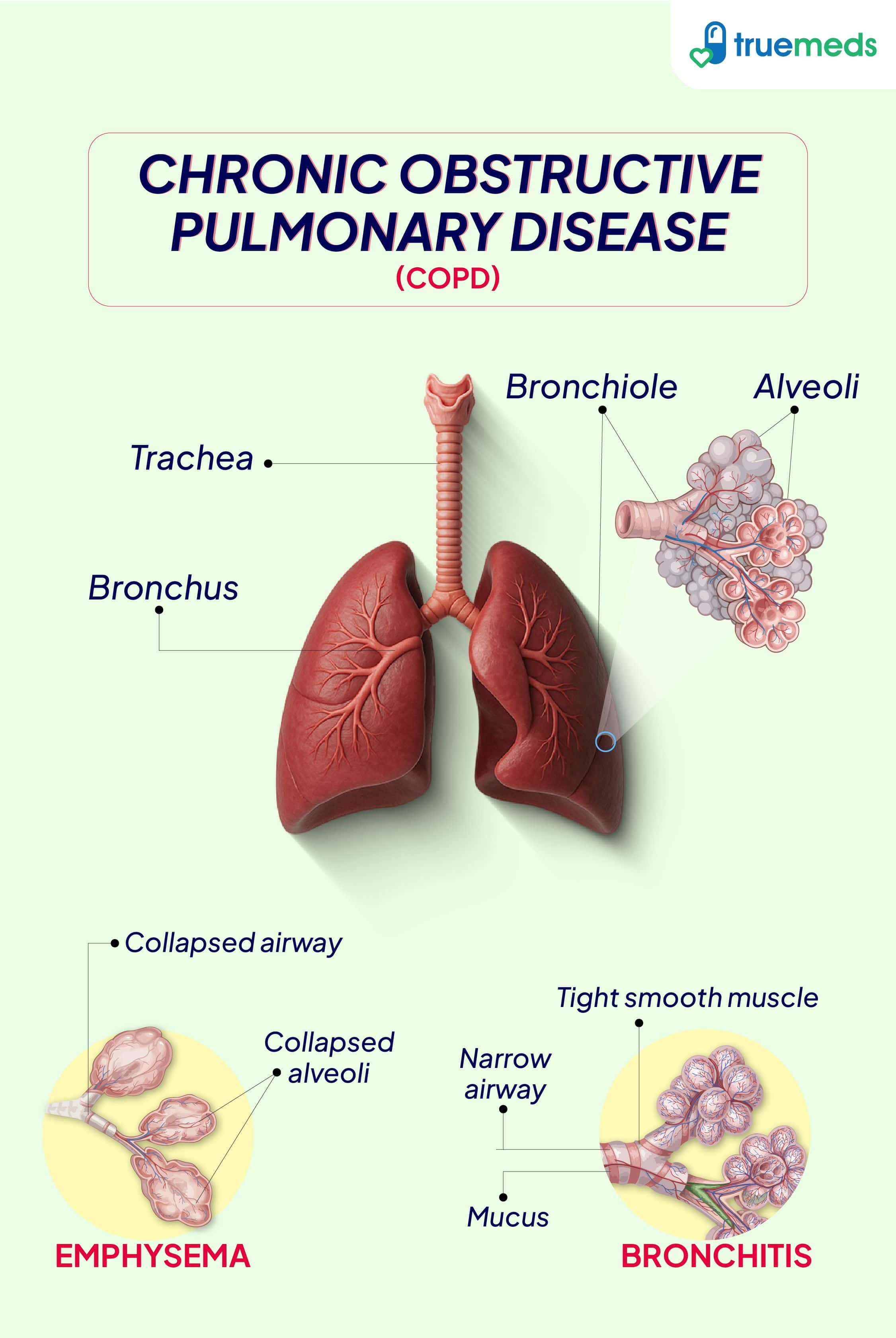 Chronic Obstructive Pulmonary Disease (COPD)