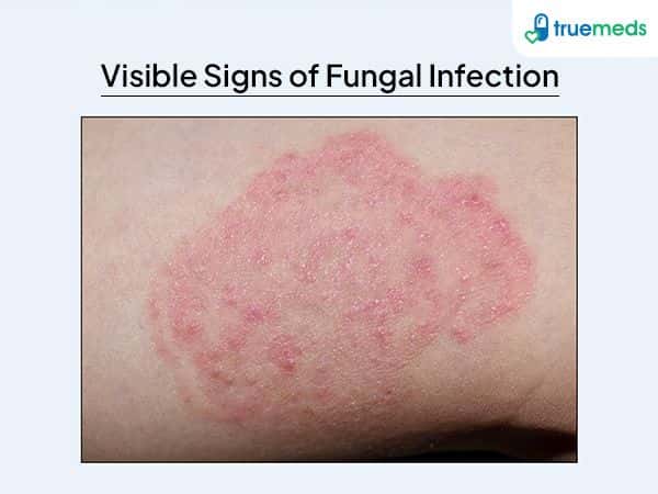 image of fungal infection 