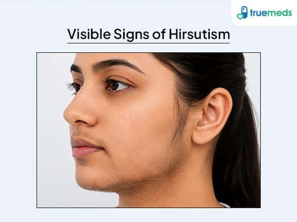 image of hirsutism