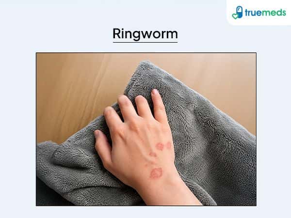 image of ringworm 