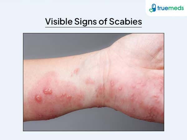 image of scabies