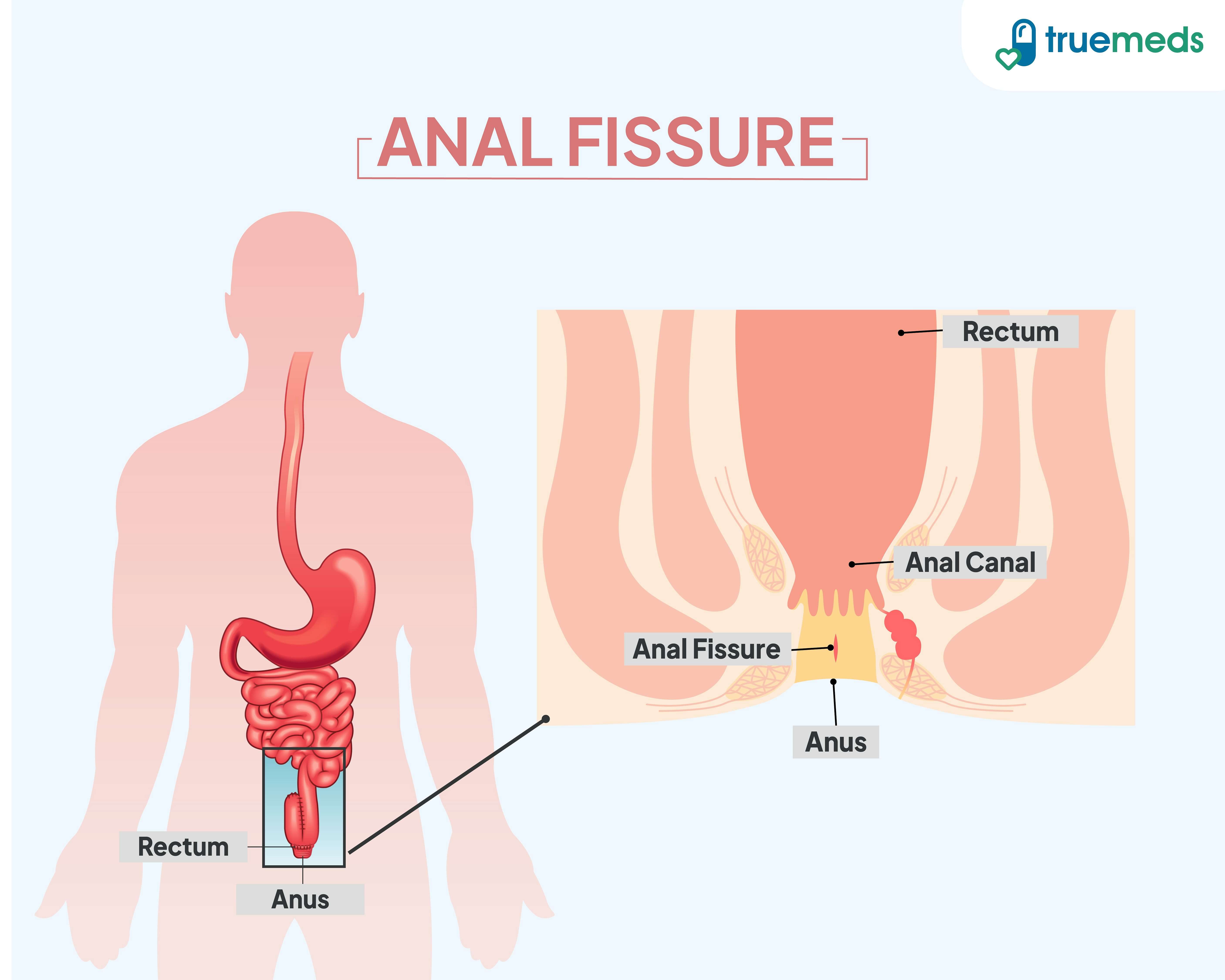 Diagram showing the location of anal fissure with labeled rectum, anal canal, and anus