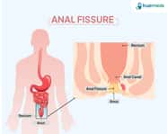 Anal Fissure Specialists Anal Fissure Specialists