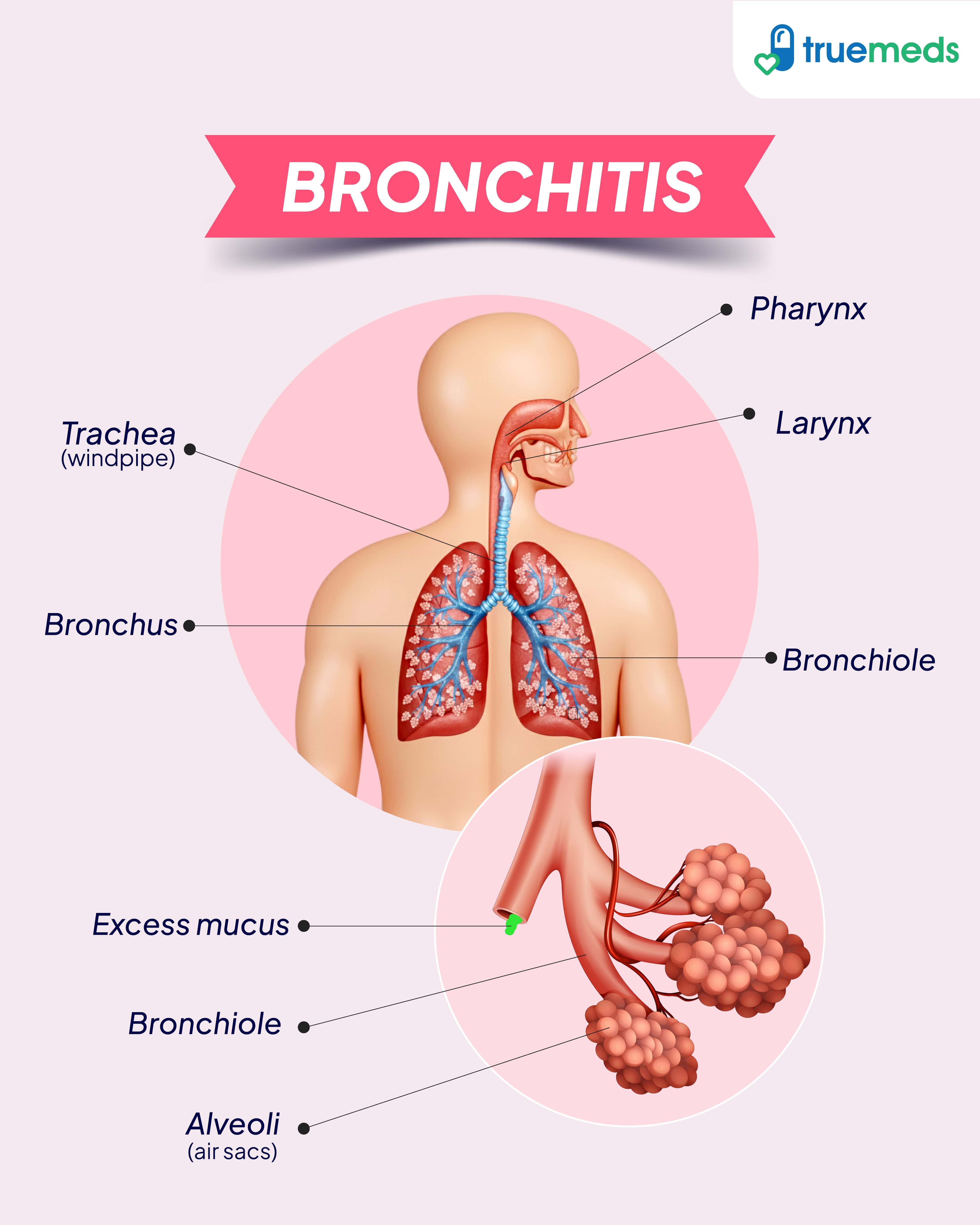 bronchitis visual representation