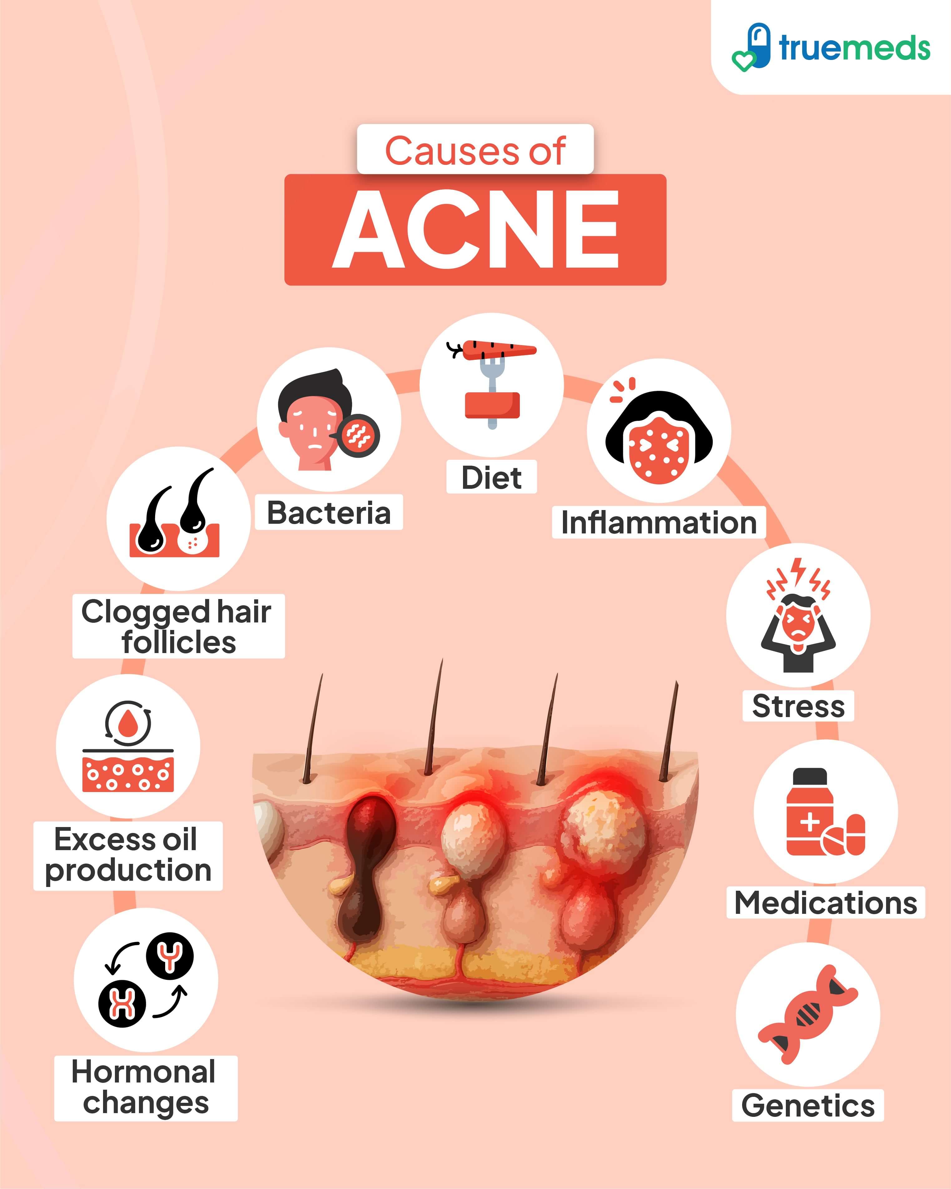 Infographic showing common causes of acne including bacteria, clogged pores, excess oil, hormones, stress, diet, medications, and genetics