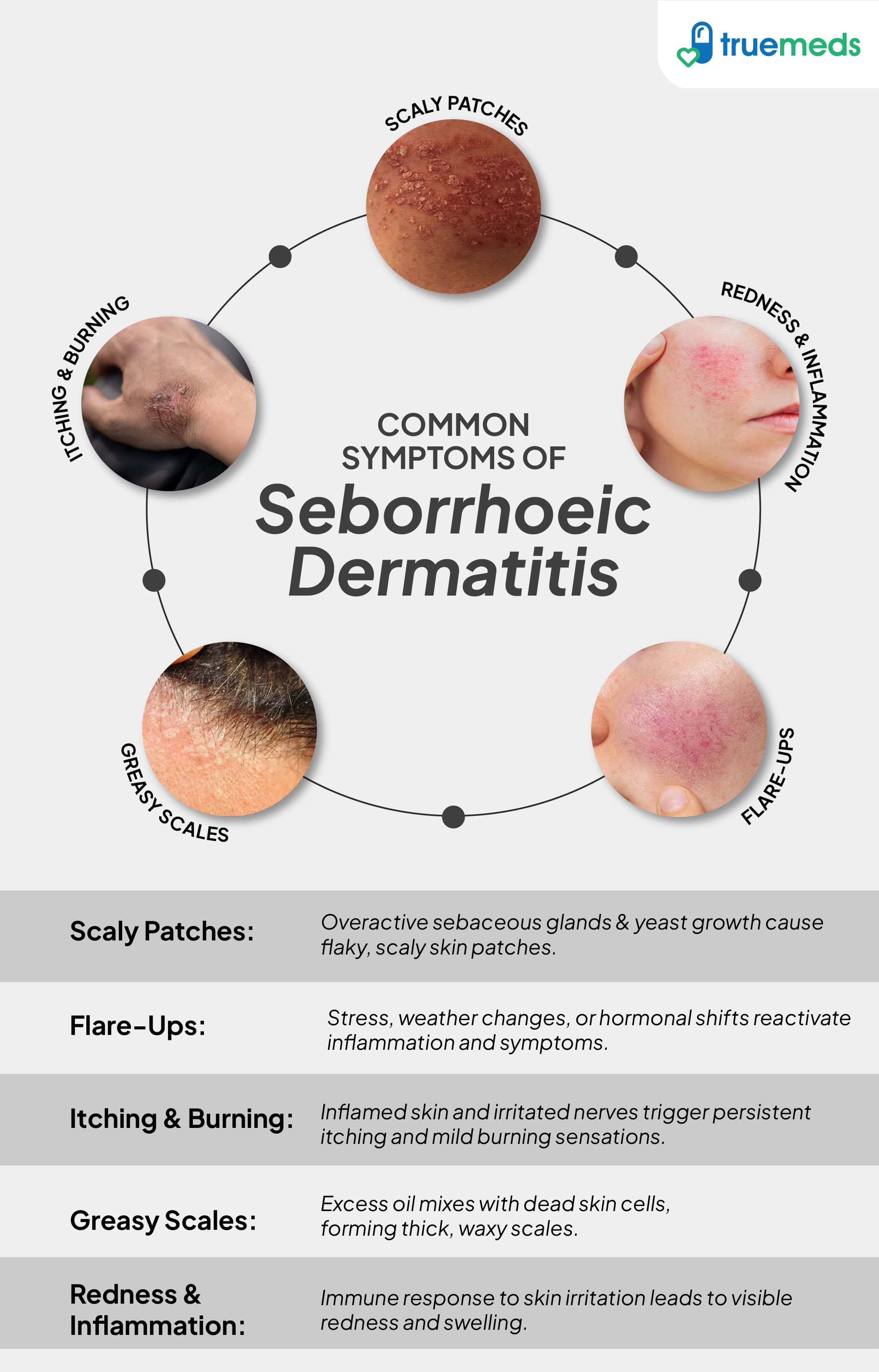 Common Symptoms of Seborrhoeic Dermatitis infographic