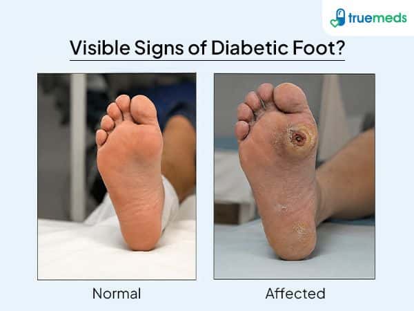 visual representation of diabetic foot
