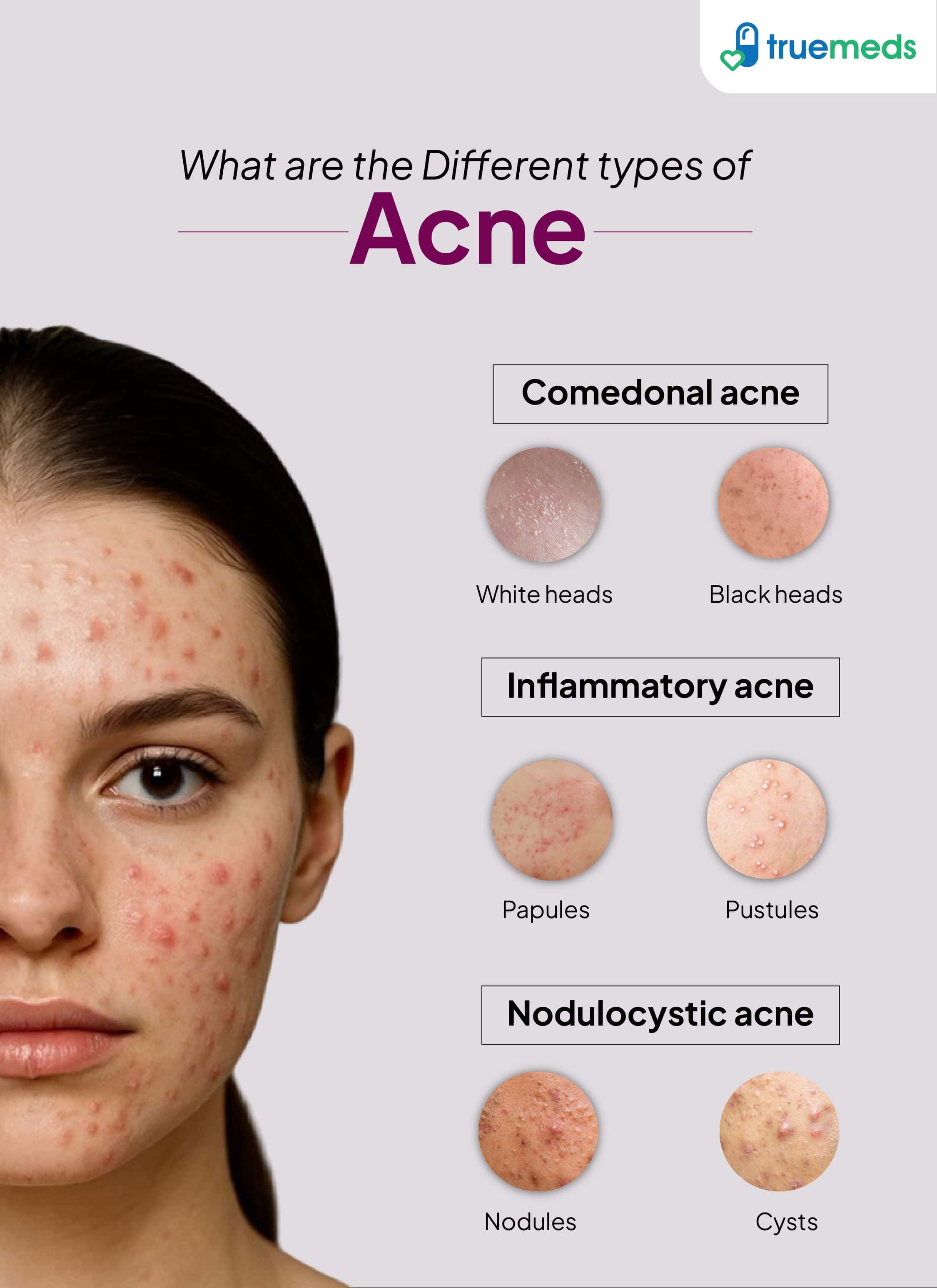 Image showing different types of acne