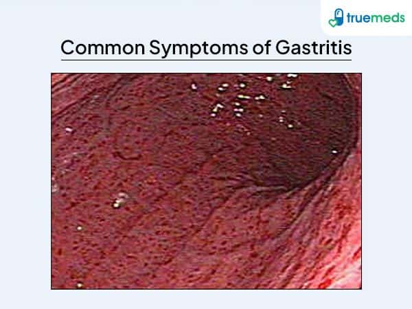 image of eye affected by gastritis