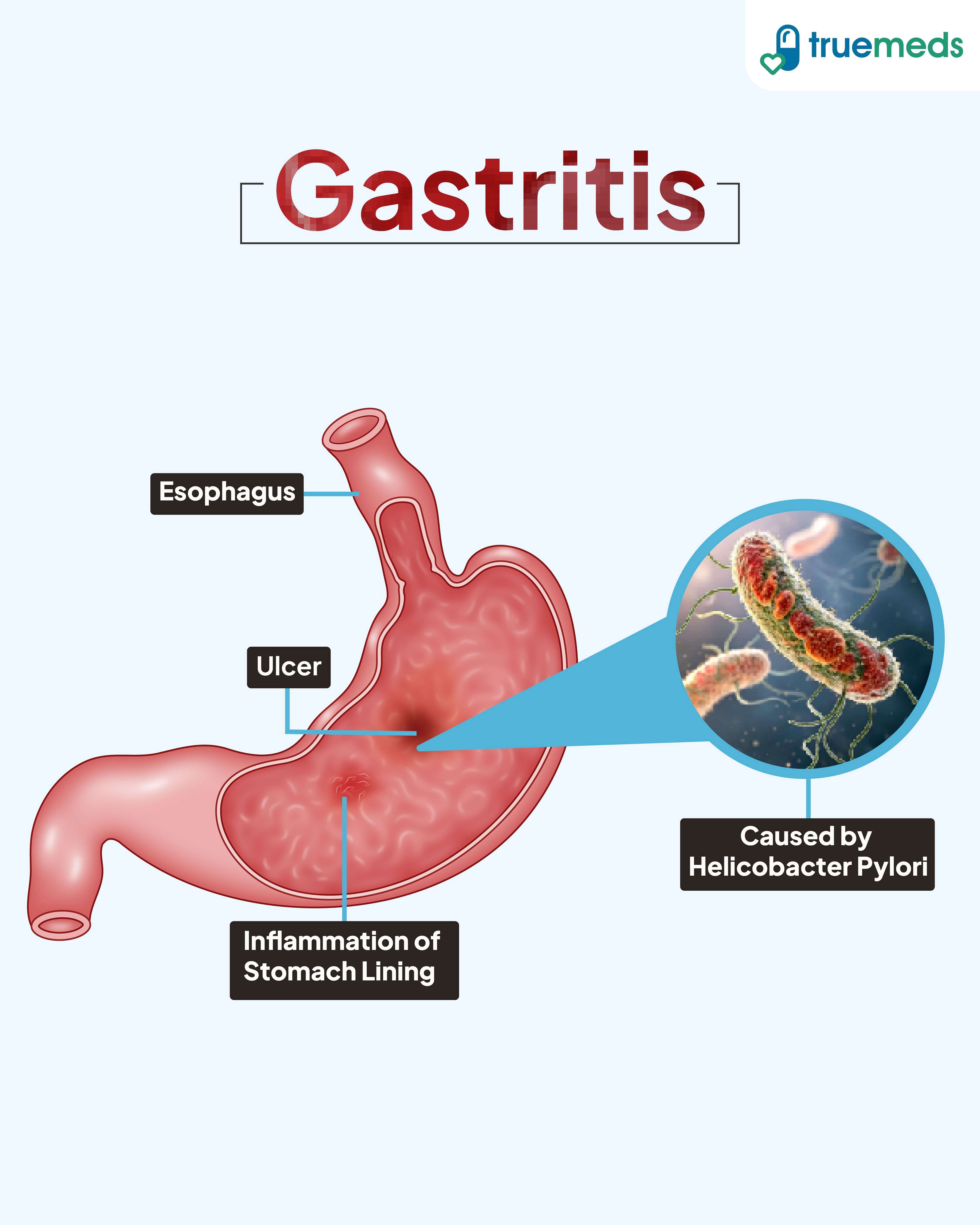 Illustration of gastritis showing stomach ulcer, inflammation, and Helicobacter pylori infection.