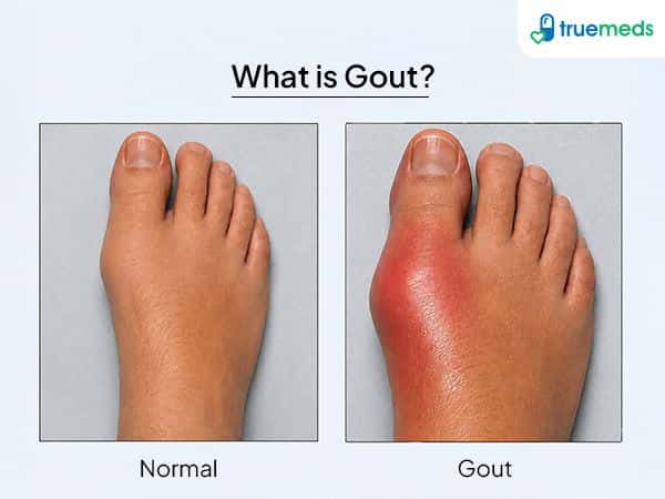 image of gout