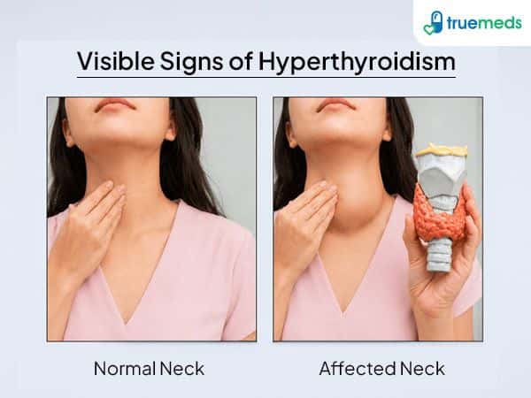 visual representation of hyperthyroidism