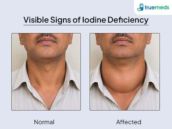 image of visible signs of iodine deficiency