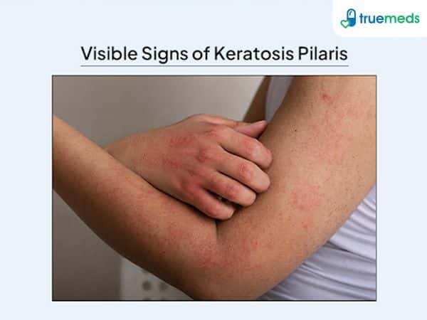 visual representation of keratosis pilaris