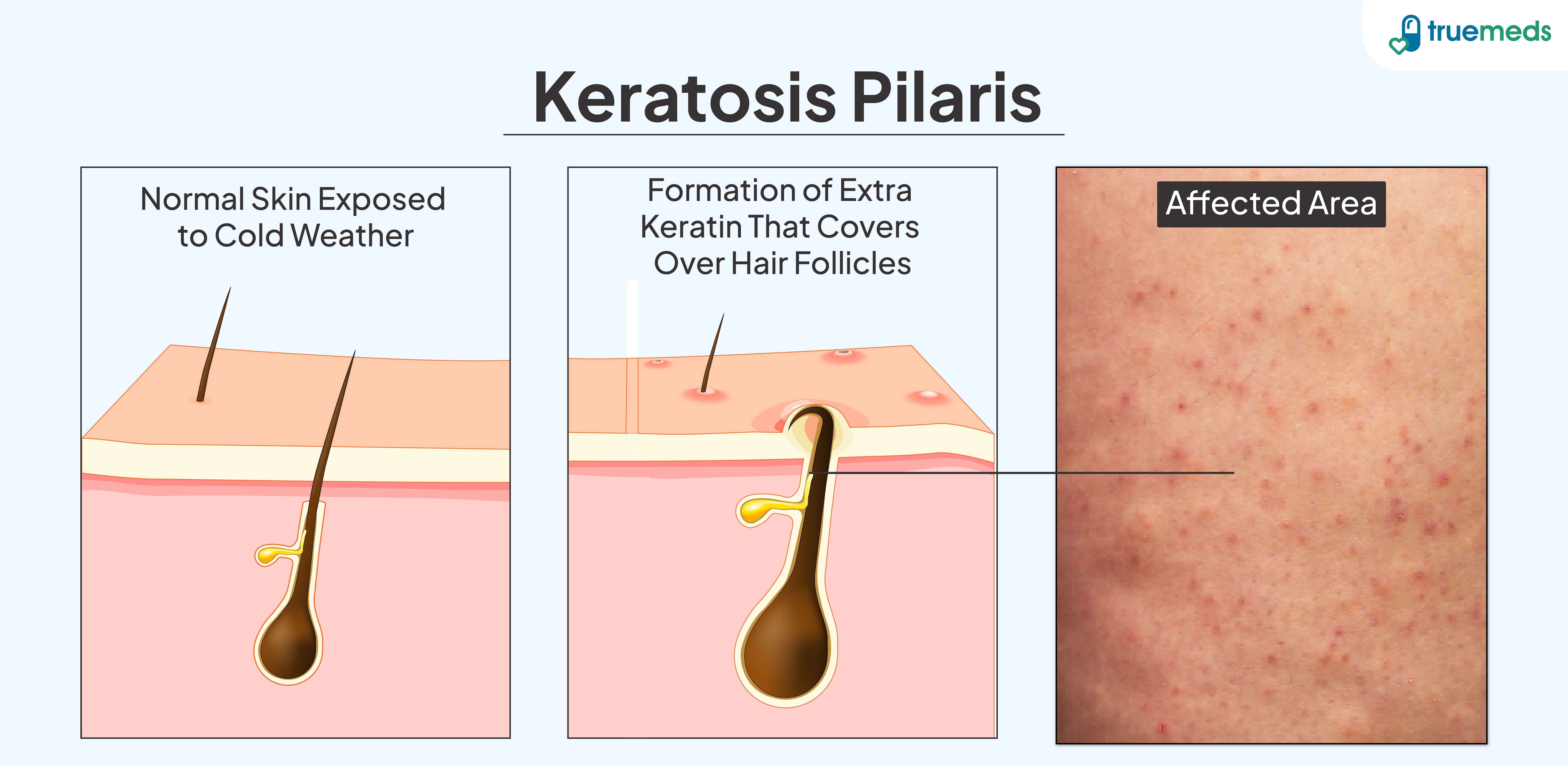 Keratosis Pilaris illustration showing normal skin, keratin buildup over hair follicles, and affected skin with red bumps
