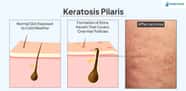 Keratosis Pilaris Treatment