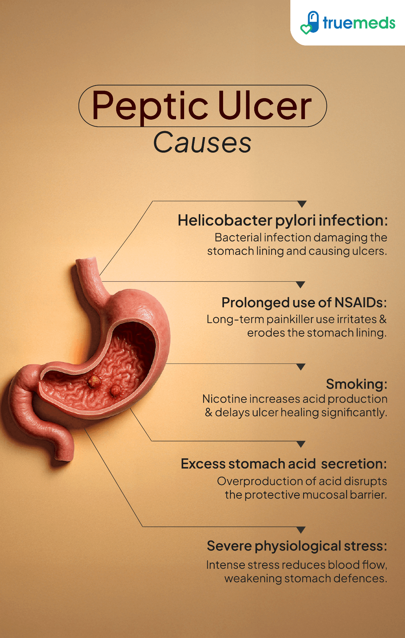 peptic ulcer causes infographic