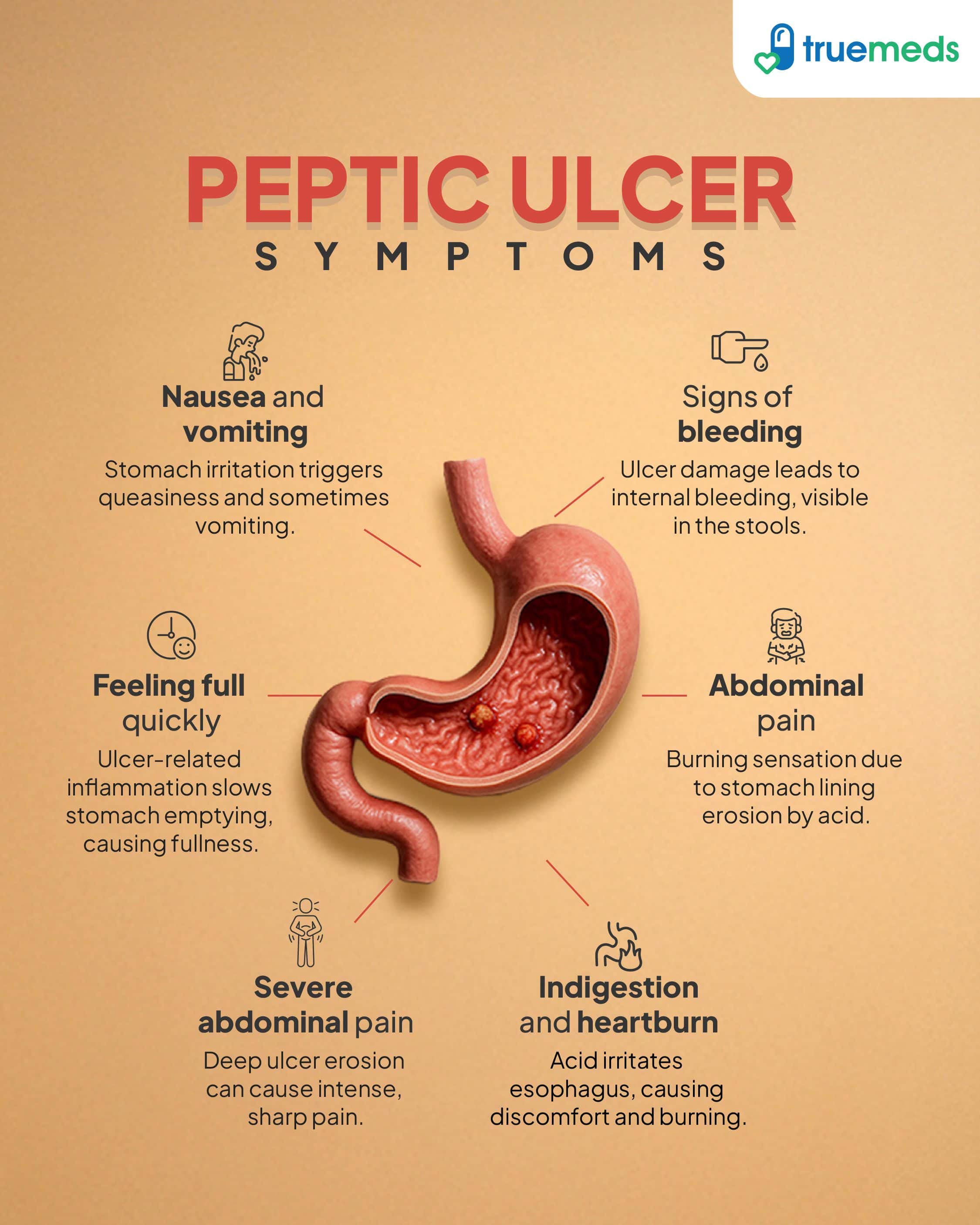Peptic Ulcer Symptoms infographic