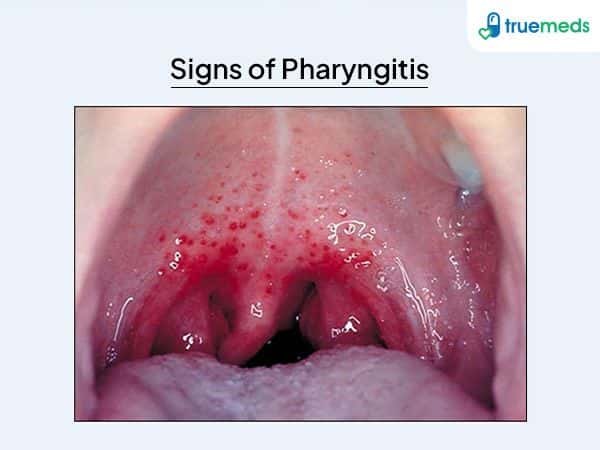 visual representation of pharyngitis