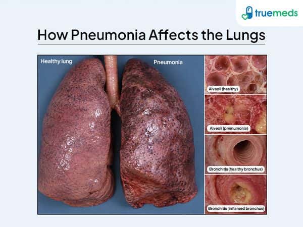 visual representation of pneumonia