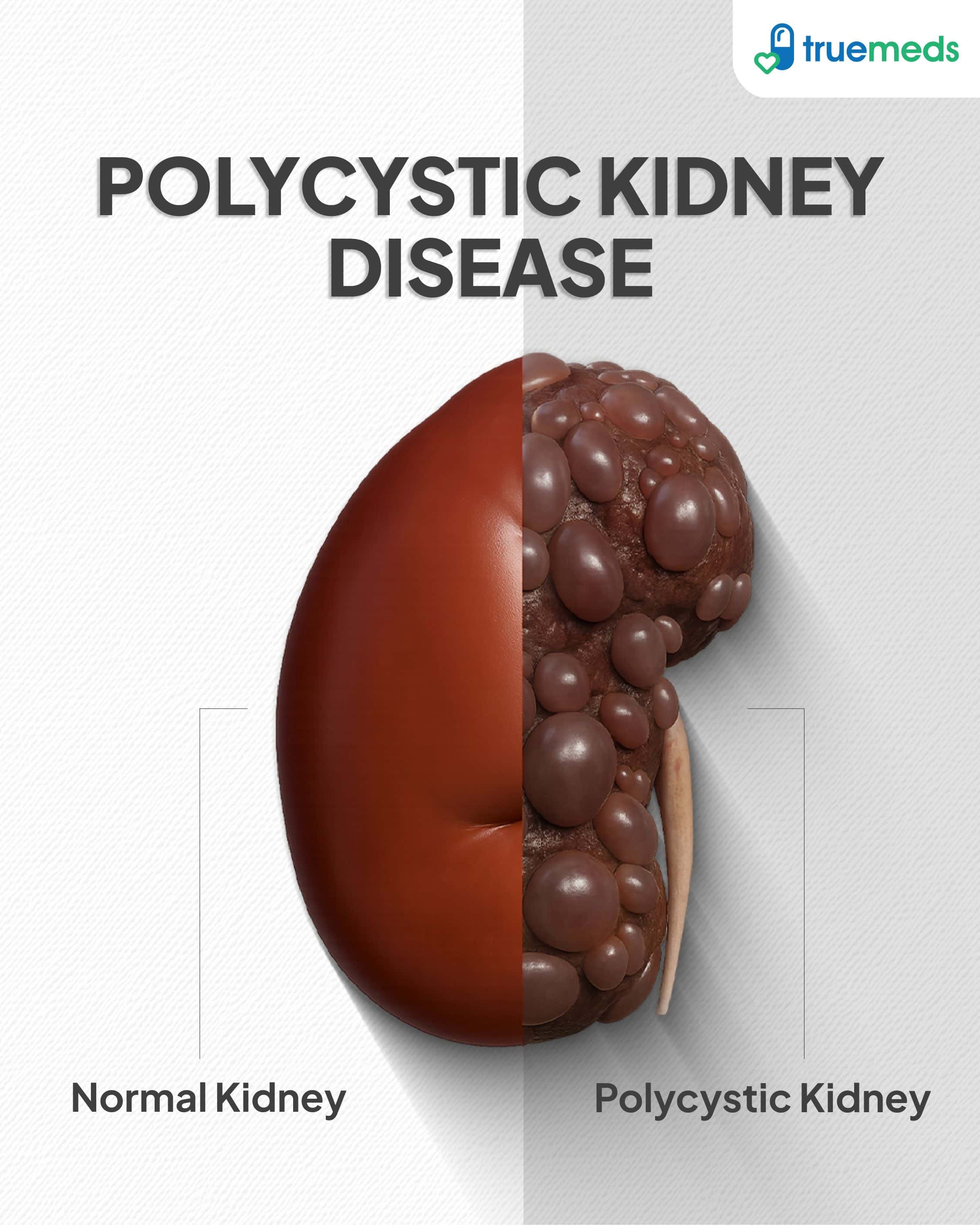 visual representation of normal kidney vs kidney affected with polycystic disease
