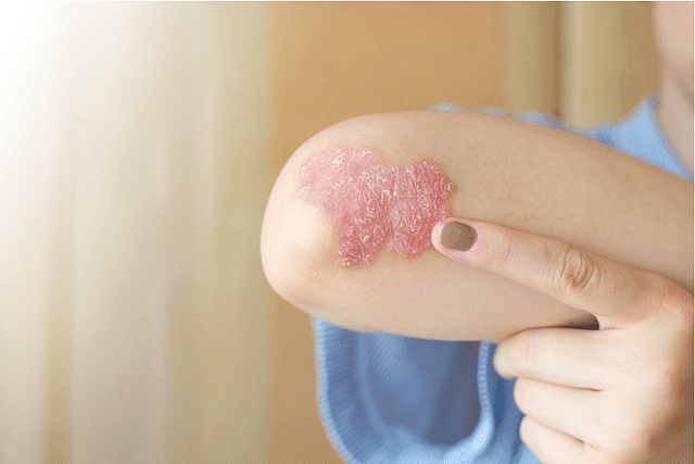 Psoriasis: Causes, Symptoms & Treatment Options