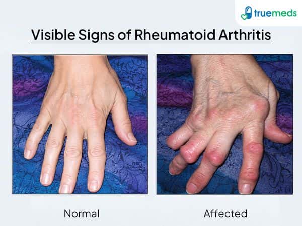 visible signes of rheumatoid arthritis