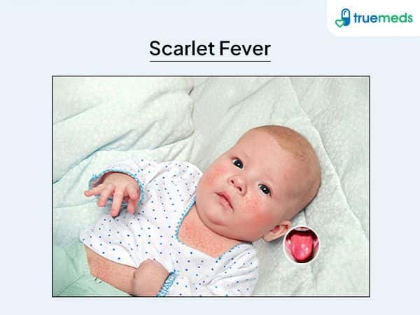 image of baby with scarlet fever