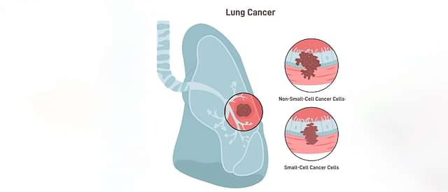 Cancer