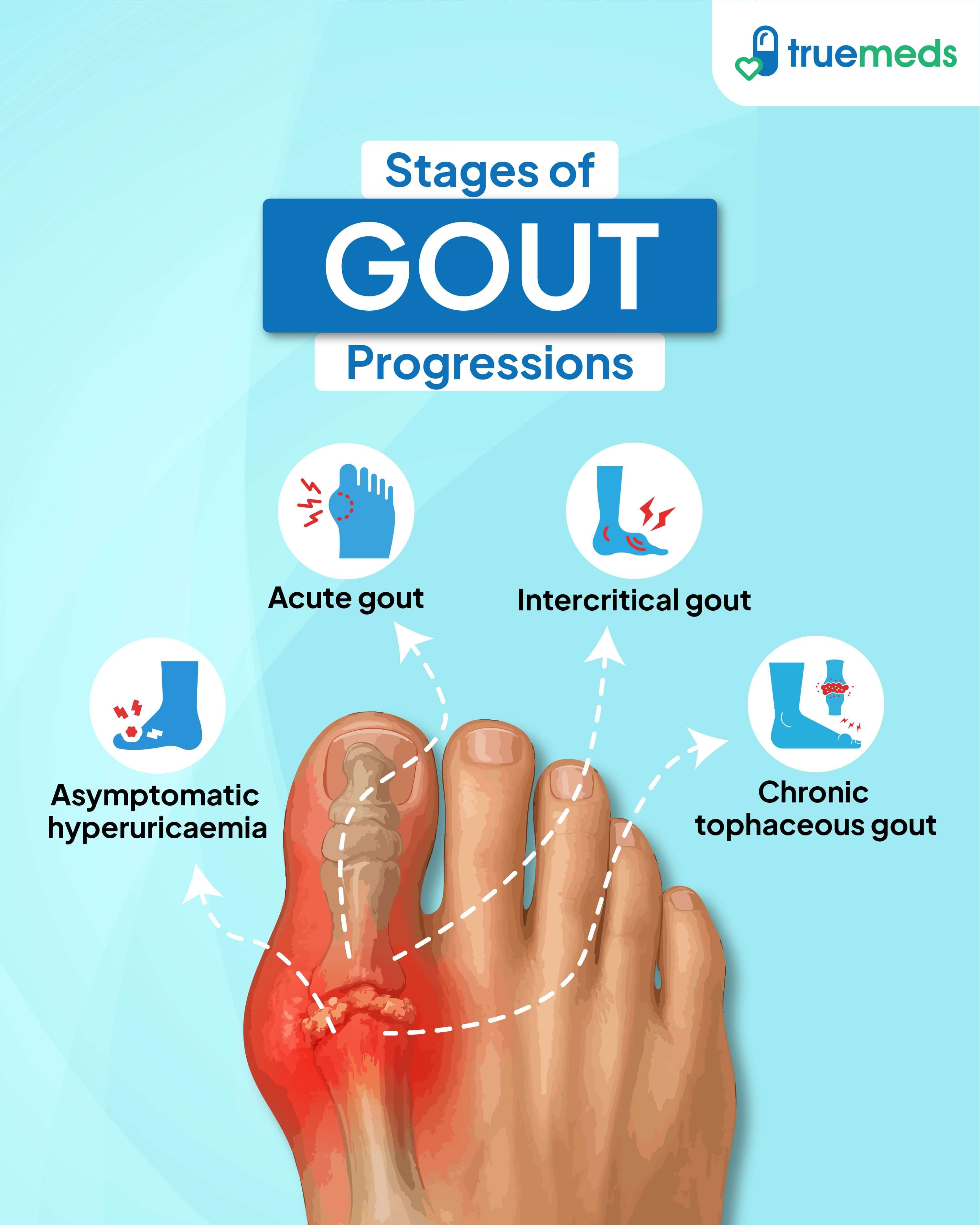 Infographic illustrating stages of gout progression including asymptomatic hyperuricaemia, acute gout, intercritical gout, and chronic tophaceous gout