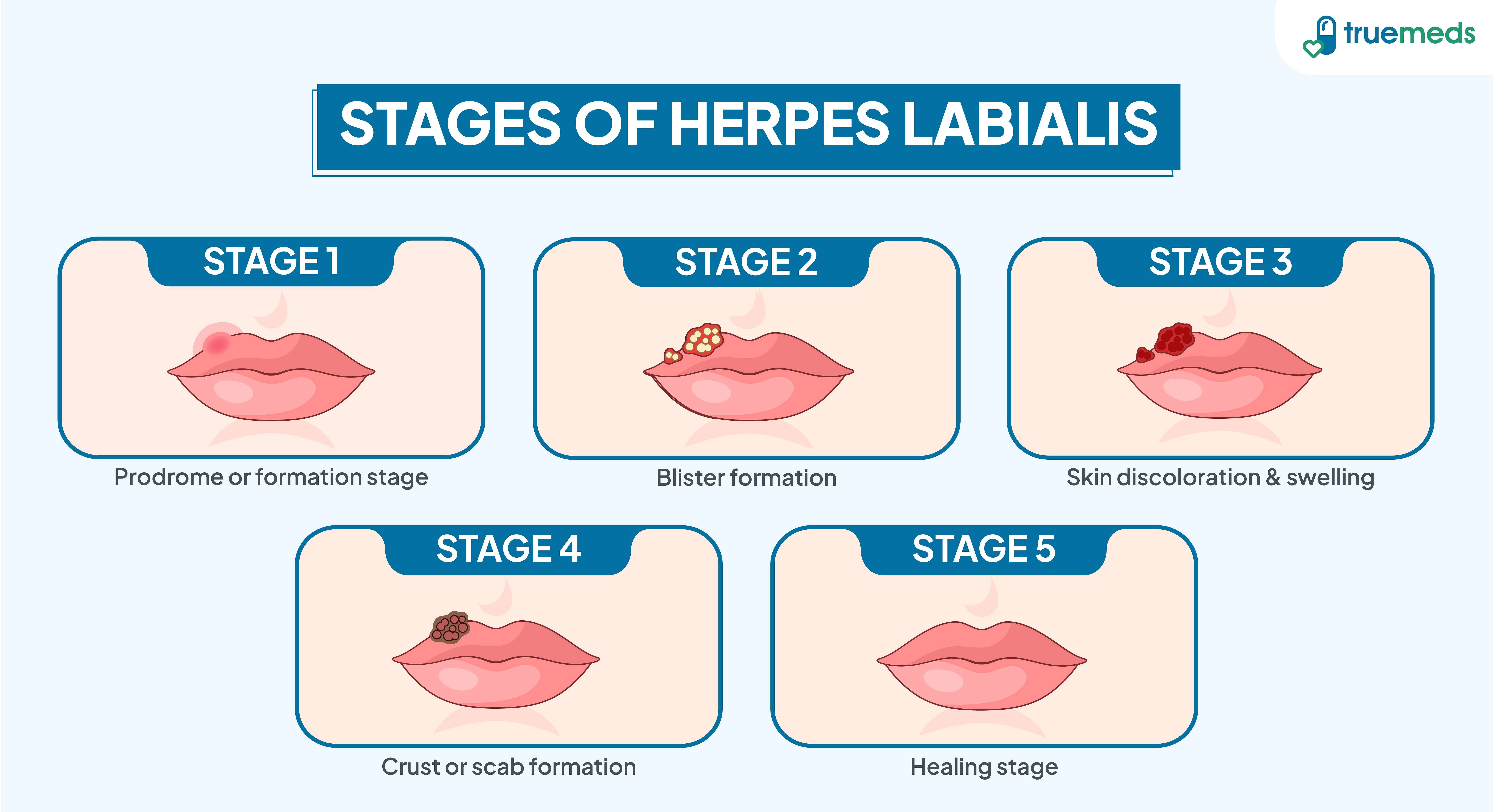 Infographic illustrating the five stages of herpes labialis, from prodrome and blister formation to scab development and healing.