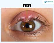 Stye Causes Symptoms Effective Treatment Options
