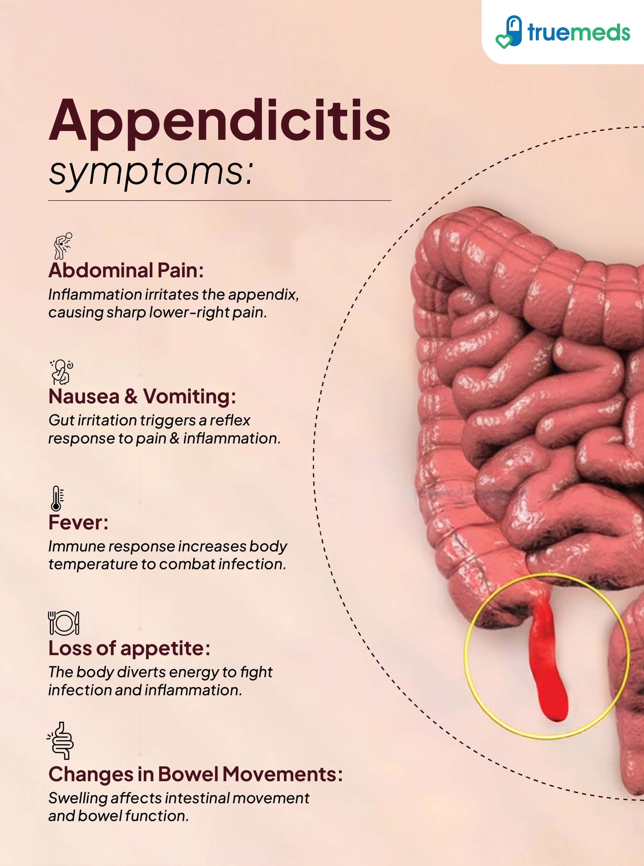 Symptoms of Appendicitis infographic