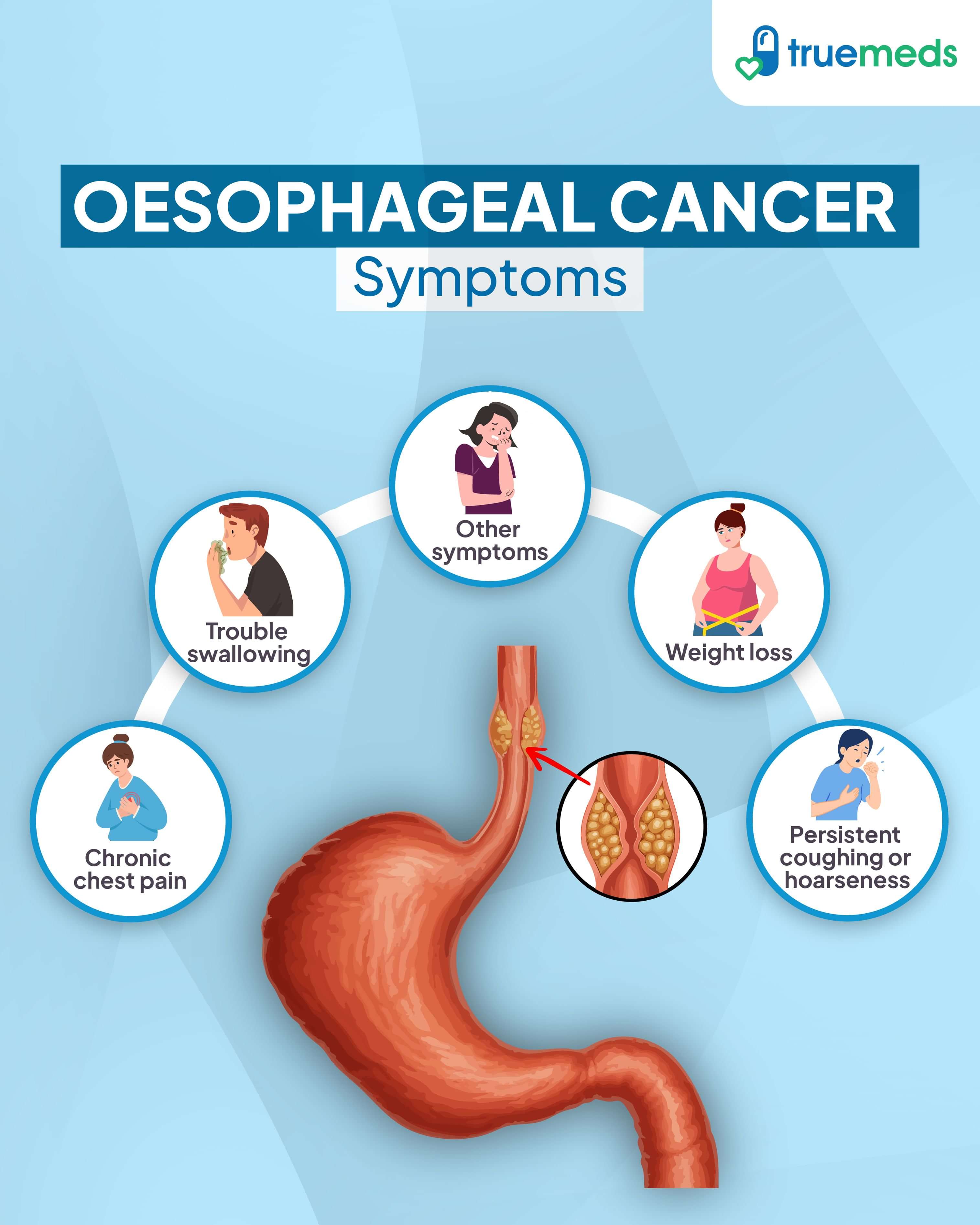 Infographic showing symptoms of oesophageal cancer like trouble swallowing, weight loss, chronic chest pain, and persistent coughing