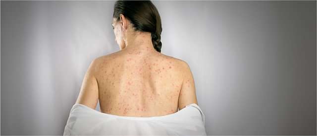 Infections