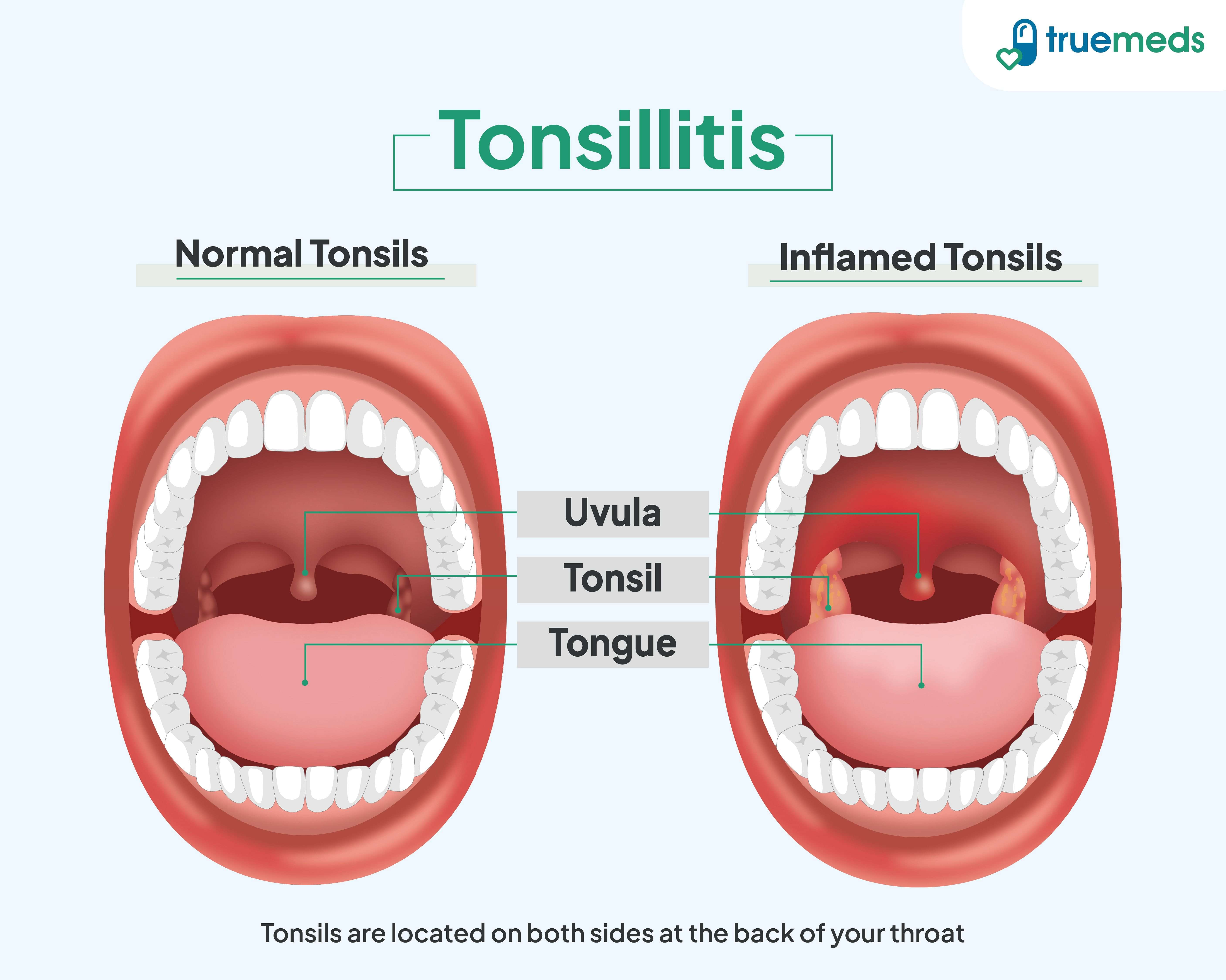 "Comparison of normal tonsils and inflamed tonsils in tonsillitis, showing uvula, tonsils, and tongue anatomy.