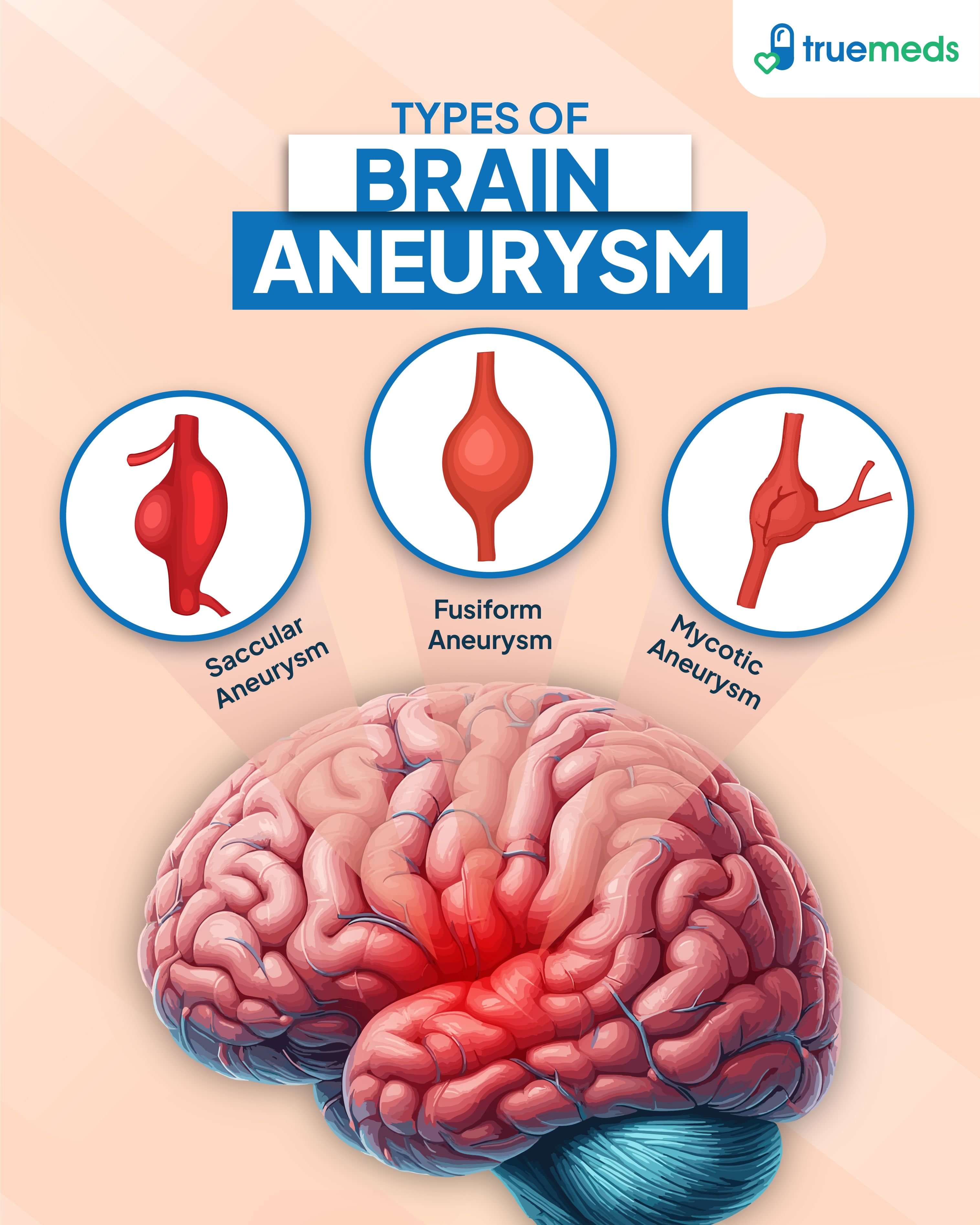 Types of brain aneurysm – saccular, fusiform, and mycotic aneurysms illustrated with human brain diagram