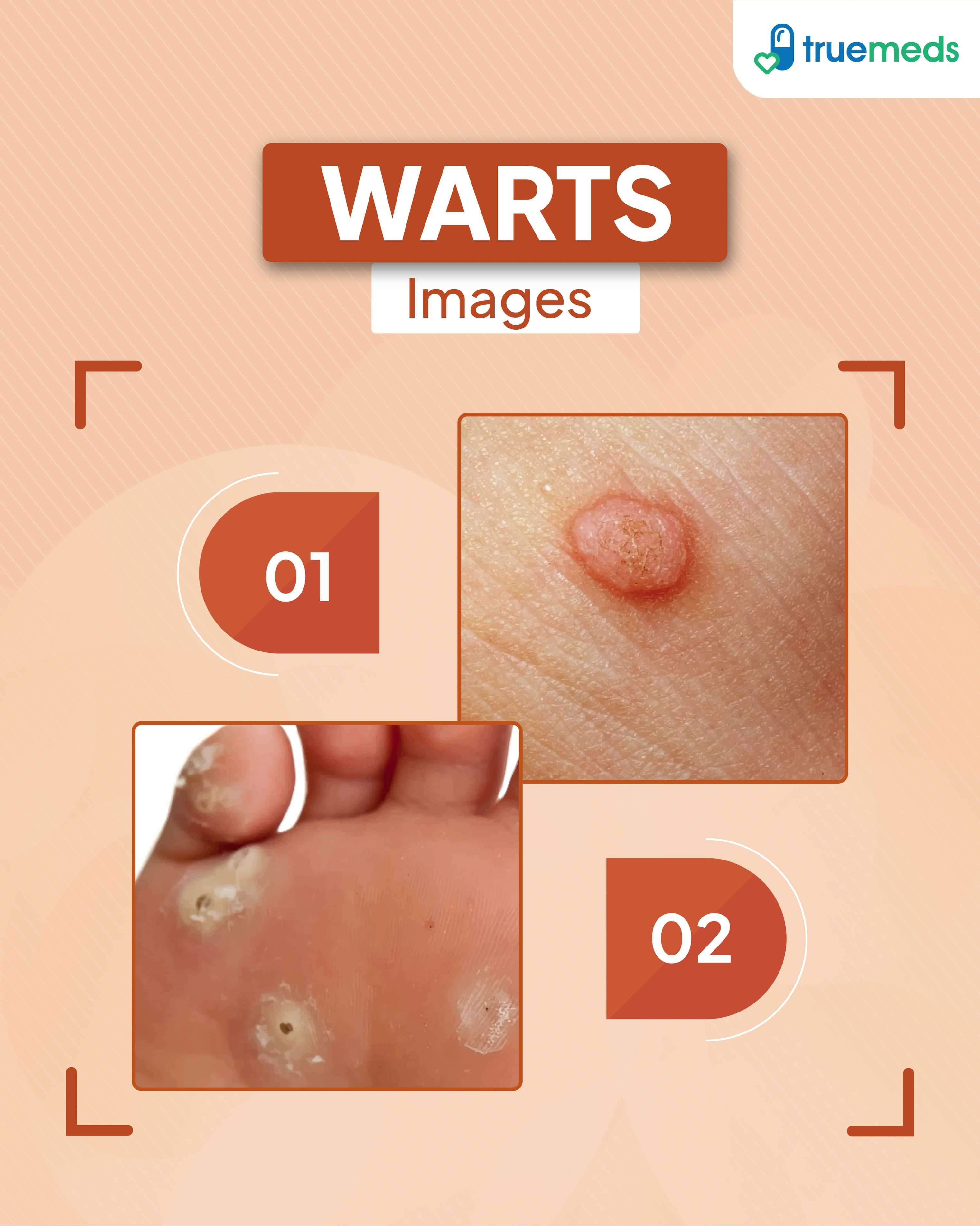 Close-up images of common warts on skin and plantar warts on foot for medical reference