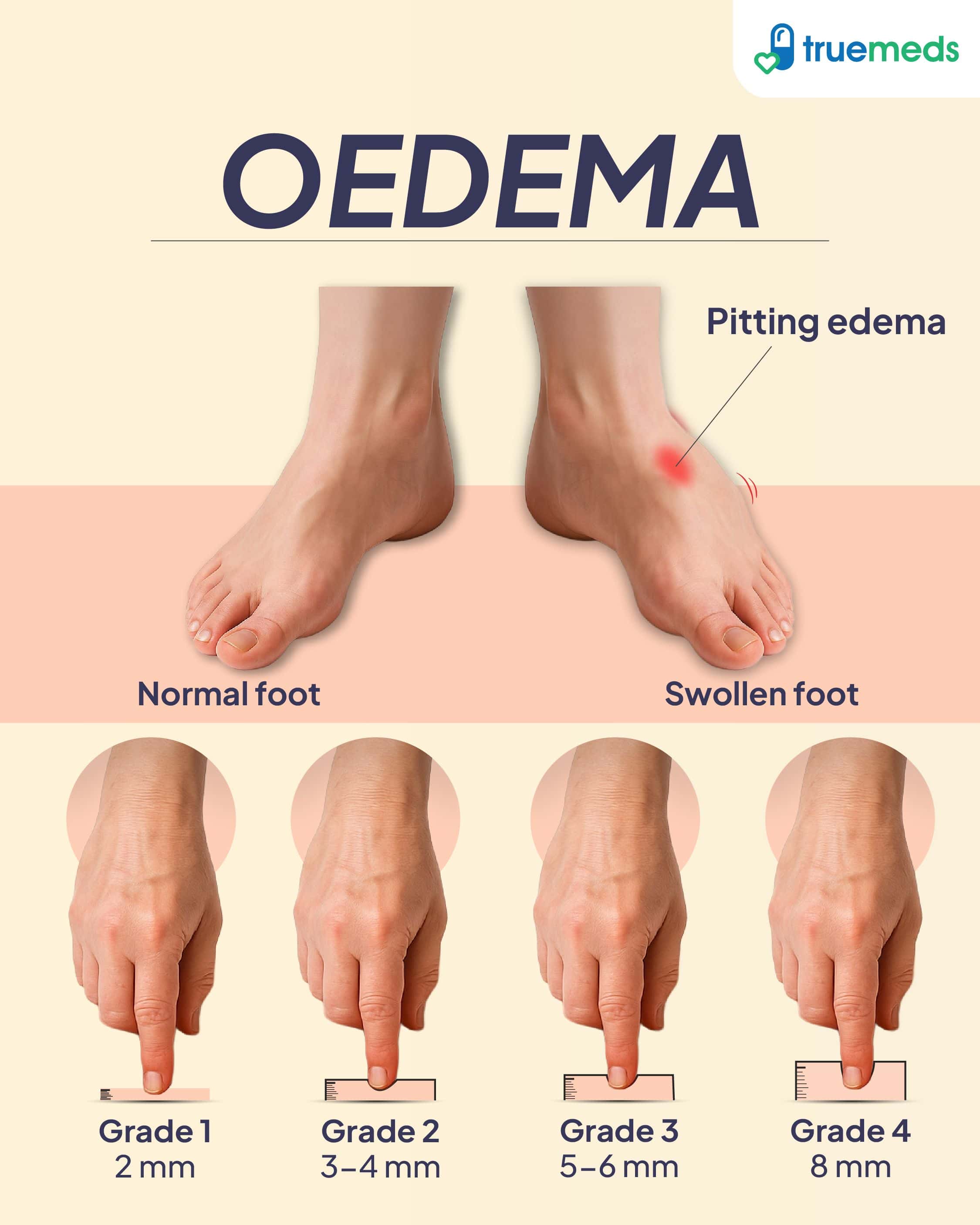 Visual representation showing normal foot and oedema, along with its stages