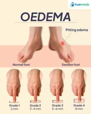 Oedema Causes Symptoms Treatment Options Oedema Causes Symptoms Treatment Options
