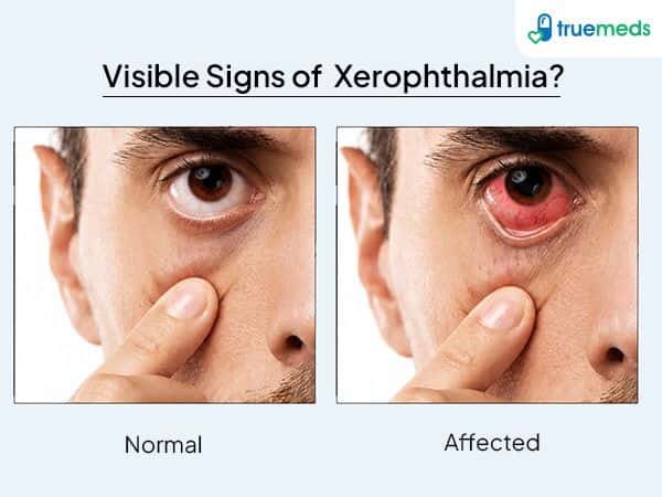 image of eye affected by xerophthalmia