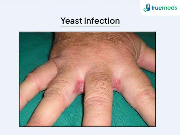 image of hand affected with yeast infection