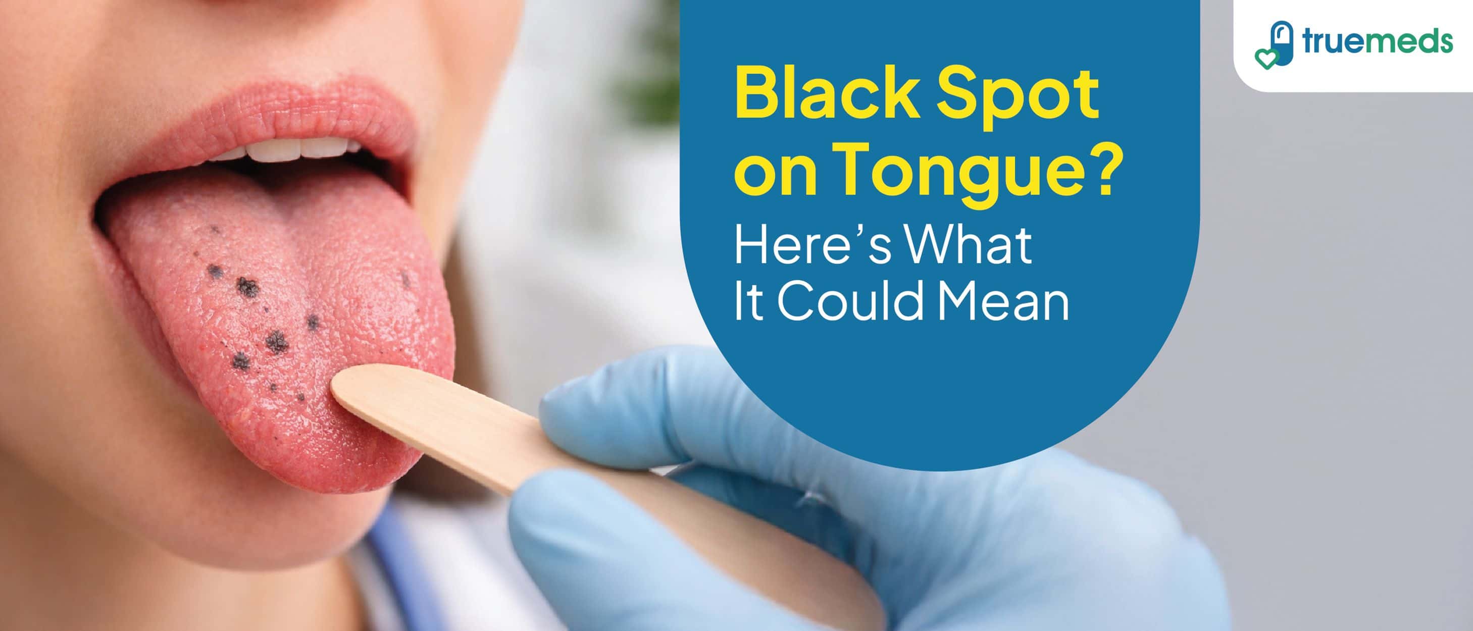 Black Spot on Tongue: Common Causes and When to Worry