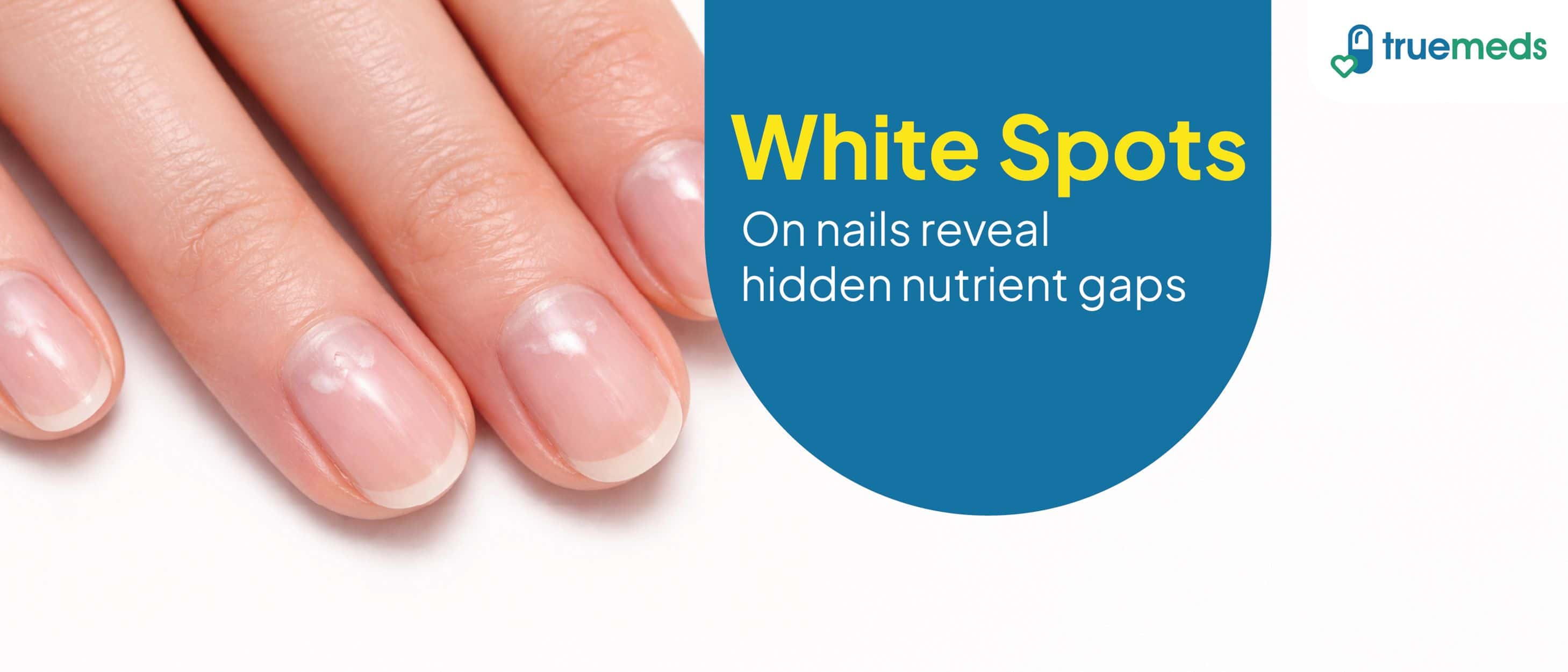 What Causes White Spots in Nails?