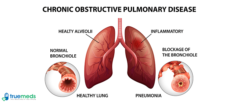 Chronic obstructive pulmonary disease (COPD)