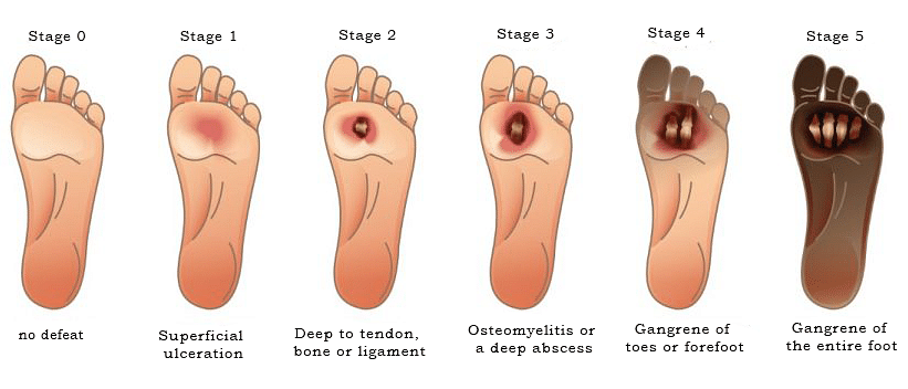 Diabetic foot ulcer stages